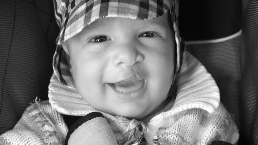 Barn med leppe-kjeve-ganespalte med lue. Smiler